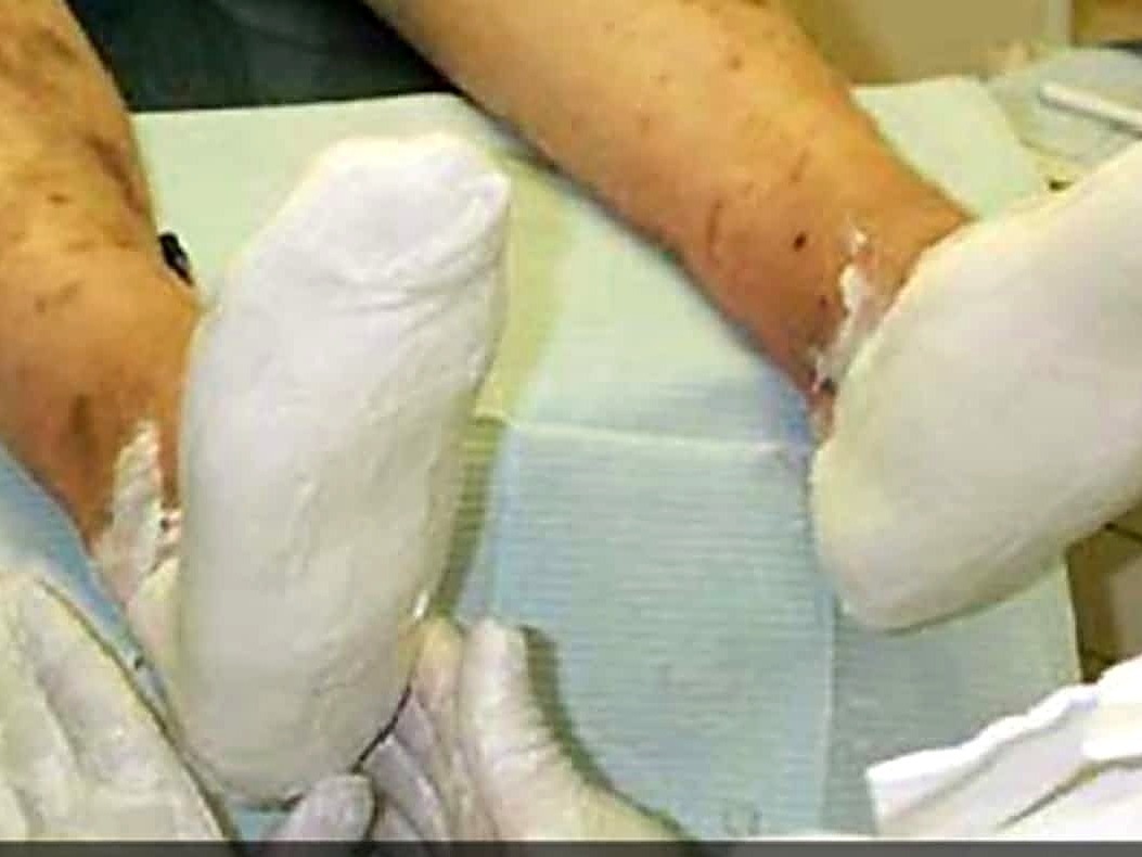 Plaster casting for custom orthotics at Atrium Foot Clinic Barrie